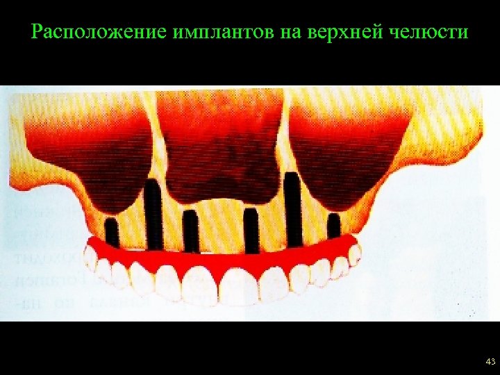 Расположение имплантов на верхней челюсти 43 