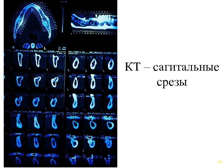 КТ – сагитальные срезы 54 