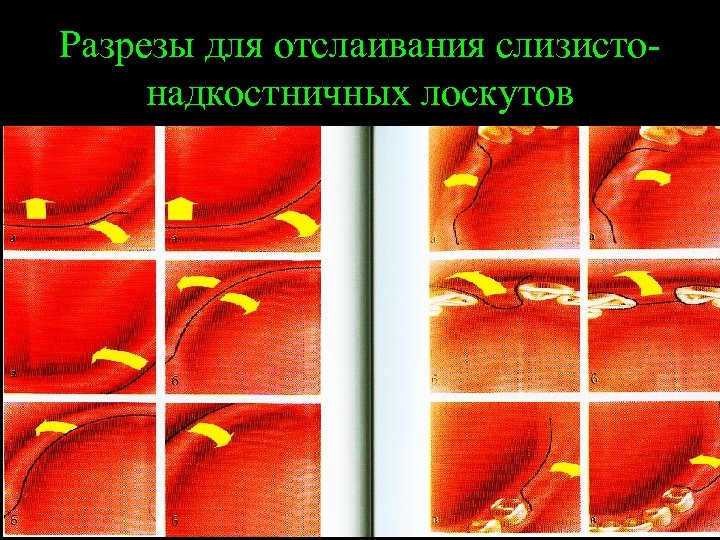 Разрезы для отслаивания слизистонадкостничных лоскутов 55 