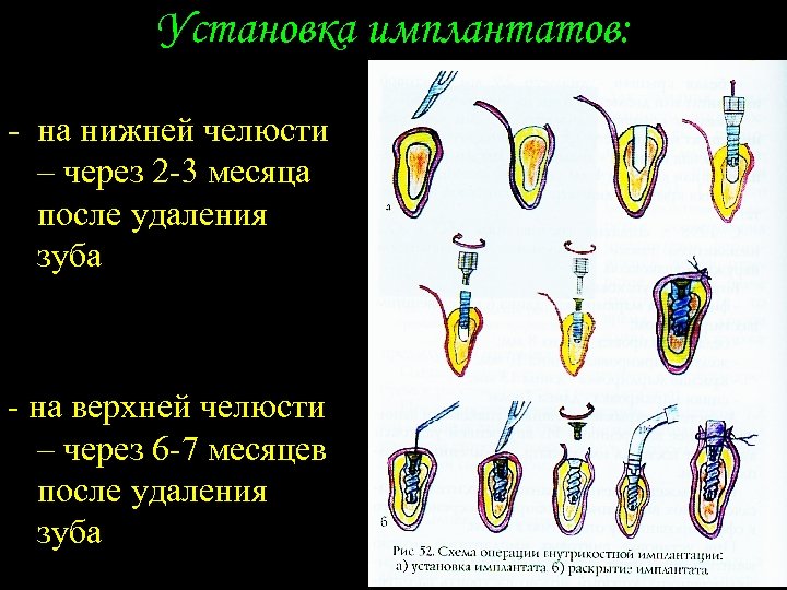 Установка имплантатов: - на нижней челюсти – через 2 -3 месяца после удаления зуба