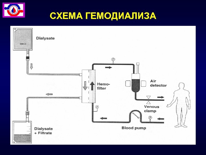 СХЕМА ГЕМОДИАЛИЗА 