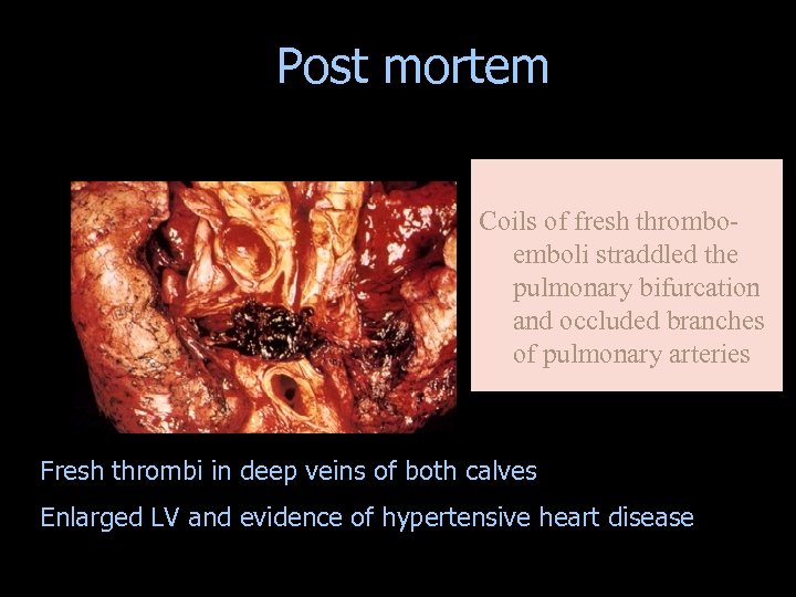 Post mortem Coils of fresh thromboemboli straddled the pulmonary bifurcation and occluded branches of