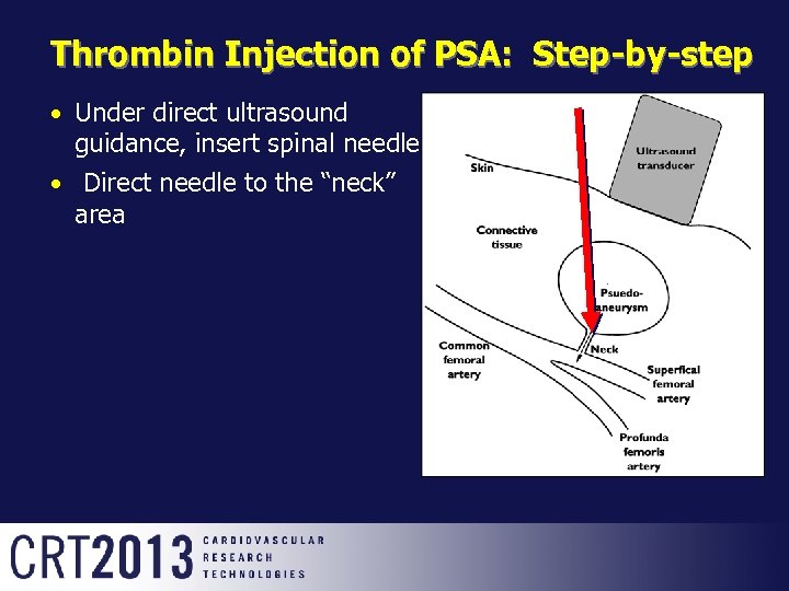 Safety And Efficacy Of Ultrasound-Guided Thrombin Injections At