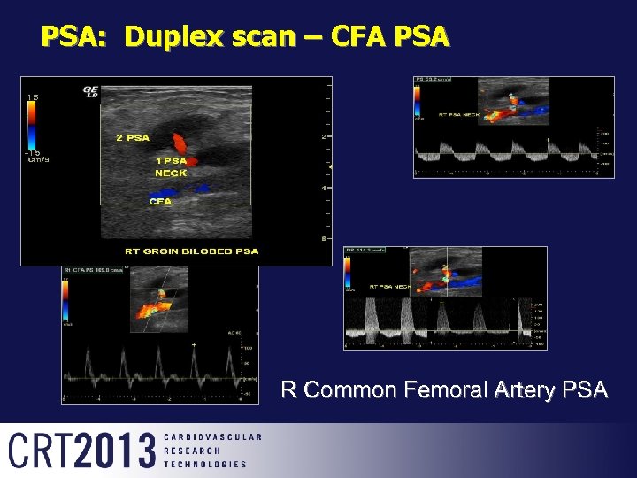 PSA: Duplex scan – CFA PSA R Common Femoral Artery PSA 