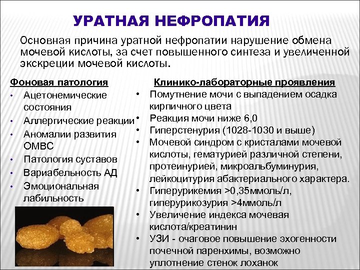 УРАТНАЯ НЕФРОПАТИЯ Основная причина уратной нефропатии нарушение обмена мочевой кислоты, за счет повышенного синтеза