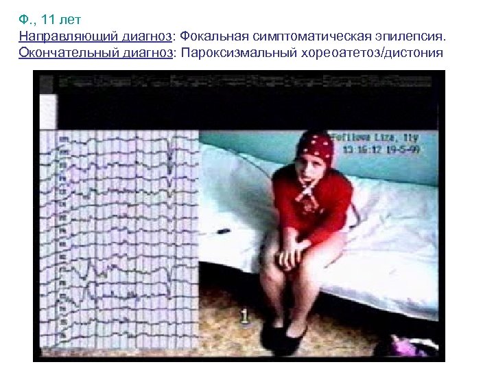 Ф. , 11 лет Направляющий диагноз: Фокальная симптоматическая эпилепсия. Окончательный диагноз: Пароксизмальный хореоатетоз/дистония 