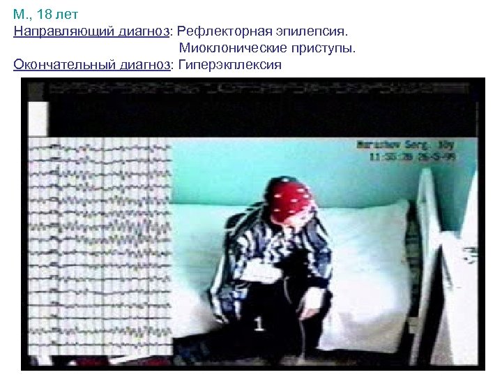 М. , 18 лет Направляющий диагноз: Рефлекторная эпилепсия. Миоклонические приступы. Окончательный диагноз: Гиперэкплексия 