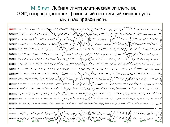 М, 5 лет. Лобная симптоматическая эпилепсия. ЭЭГ, сопровождающая фокальный негативный миоклонус в мышцах правой