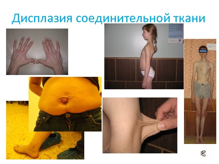 Дисплазия соединительной ткани 