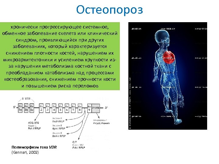 Остеопороз хронически прогрессирующее системное, обменное заболевание скелета или клинический синдром, проявляющийся при других заболеваниях,