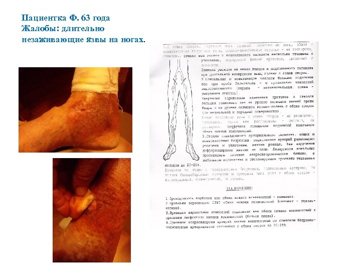 Пациентка Ф. 63 года Жалобы: длительно незаживающие язвы на ногах. 