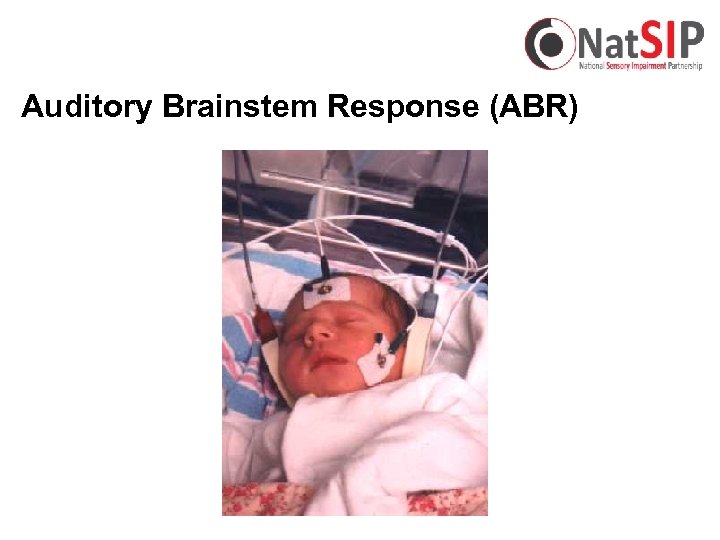 Auditory Brainstem Response (ABR) 