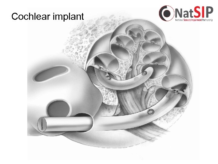 Cochlear implant 