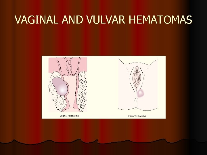 VAGINAL AND VULVAR HEMATOMAS 