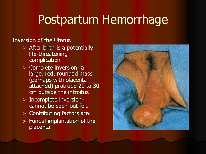 Postpartum Hemorrhage Inversion of the Uterus Ø After birth is a potentially life-threatening complication