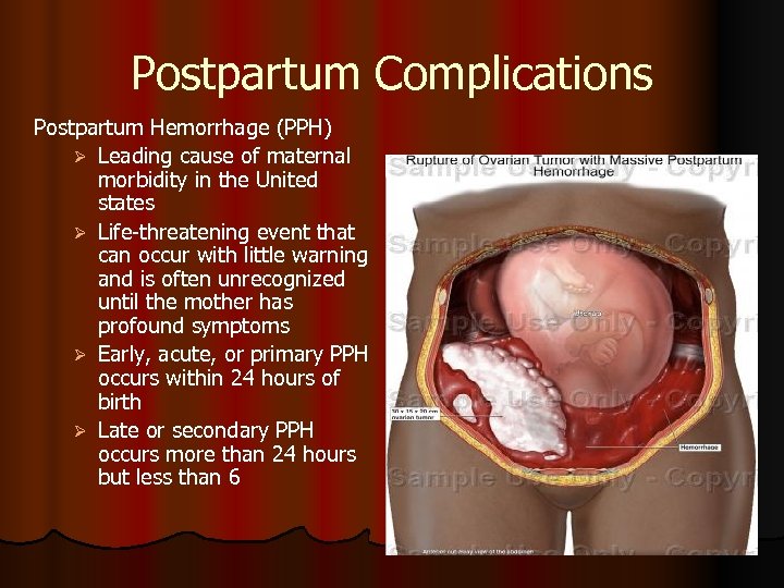 Postpartum Complications Postpartum Hemorrhage (PPH) Ø Leading cause of maternal morbidity in the United