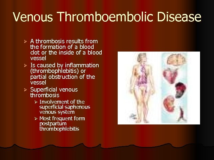 Venous Thromboembolic Disease A thrombosis results from the formation of a blood clot or