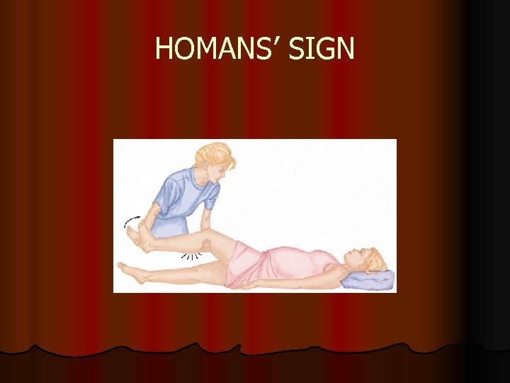 HOMANS’ SIGN 