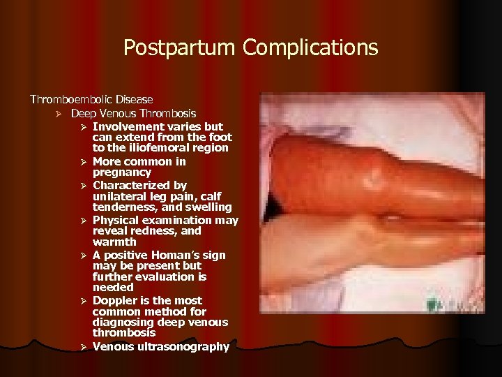 Postpartum Complications Thromboembolic Disease Ø Deep Venous Thrombosis Ø Involvement varies but can extend