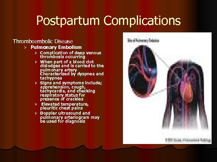 Postpartum Complications Thromboembolic Disease Ø Pulmonary Embolism Ø Complication of deep venous Ø Ø