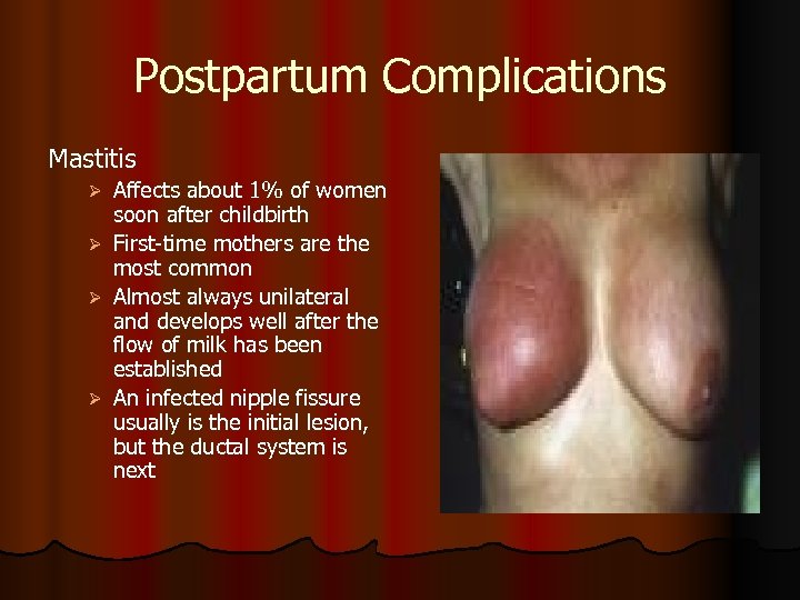 Postpartum Complications Mastitis Affects about 1% of women soon after childbirth Ø First-time mothers