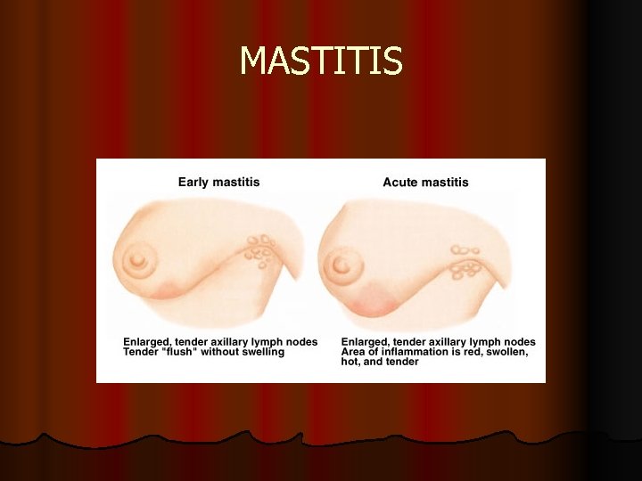 MASTITIS 