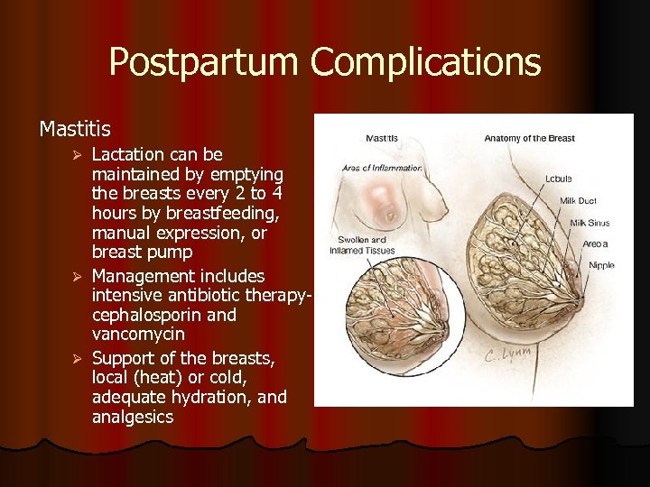 Postpartum Complications Mastitis Lactation can be maintained by emptying the breasts every 2 to