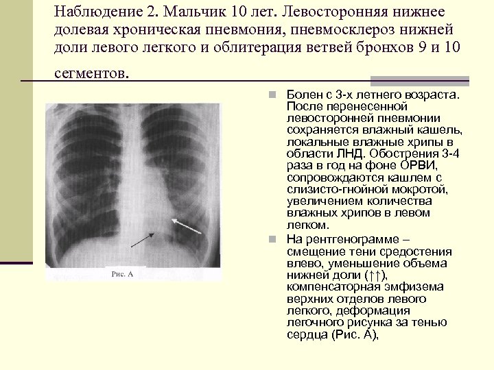 Легочный рисунок усилен в прикорневых отделах