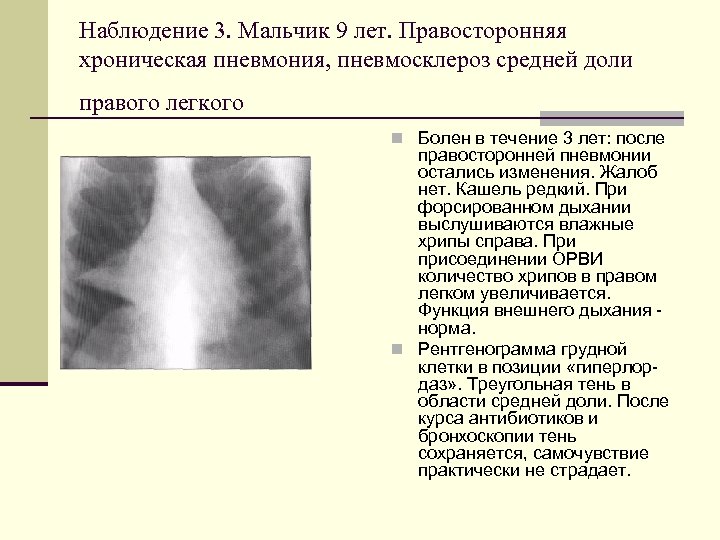 Пневмосклероз легких что. Пневмосклероз рентген. Пневмония средней доли. Правосторонняя среднедолевая пневмония. Пневмония средней доли легкого.