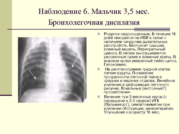 Легочный рисунок при пневмонии