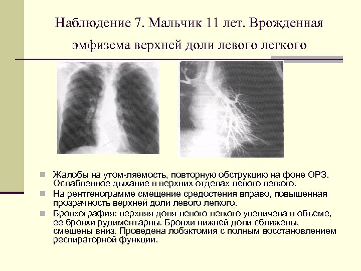 Прикорневой легочный рисунок. Парасептальная эмфизема верхних долей легких.. Викарная эмфизема рентген. Хроническая очаговая эмфизема. Эмфизема верхних долей легкого.