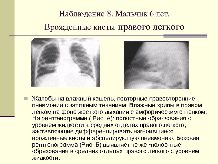 Наблюдение 8. Мальчик 6 лет. Врожденные кисты правого легкого n Жалобы на влажный кашель,