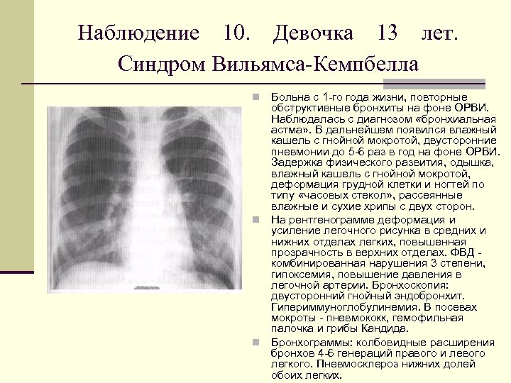 Усиление легочного рисунка в нижних отделах легких