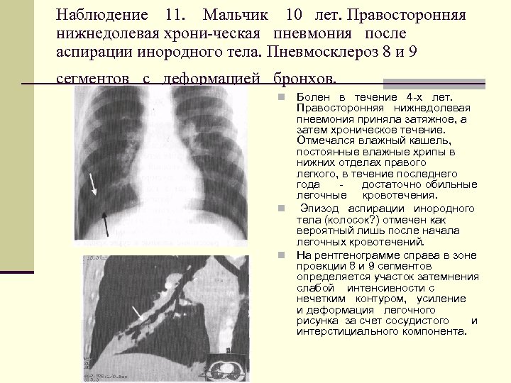 Правосторонняя пневмония у ребенка