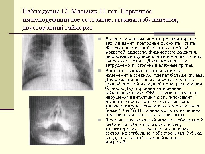 Наблюдение 12. Мальчик 11 лет. Первичное иммунодефицитное состояние, агаммаглобулинемия, двусторонний гайморит Болен с рождения: