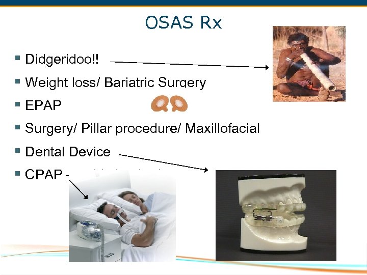 OSAS Rx § Didgeridoo!! § Weight loss/ Bariatric Surgery § EPAP § Surgery/ Pillar