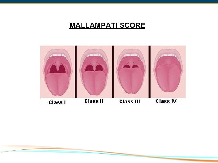 MALLAMPATI SCORE 