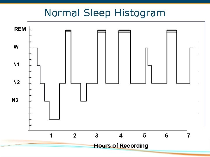 Normal Sleep Histogram REM W N 1 N 2 N 3 1 2 3