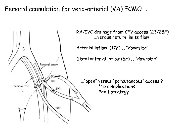 Femoral cannulation for veno-arterial (VA) ECMO … RA/IVC drainage from CFV access (23/25 F)