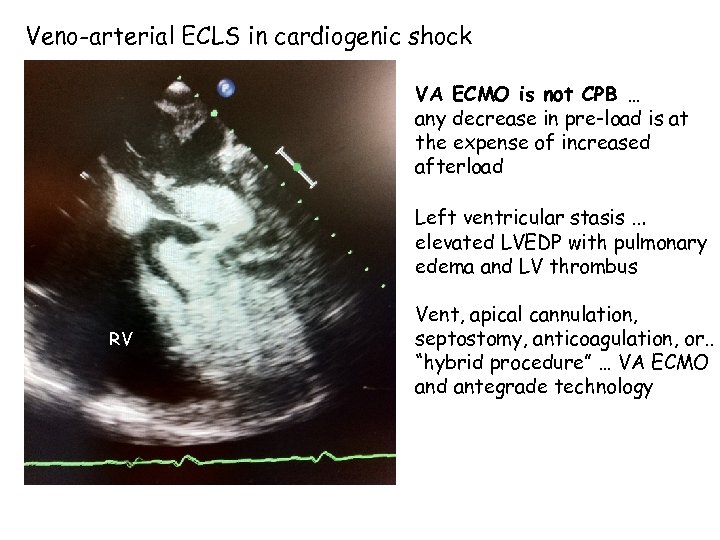 Veno-arterial ECLS in cardiogenic shock VA ECMO is not CPB … any decrease in