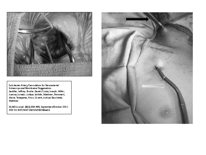 Subclavian Artery Cannulation for Venoarterial Extracorporeal Membrane Oxygenation. Javidfar, Jeffrey; Brodie, Daniel; Costa, Joseph;