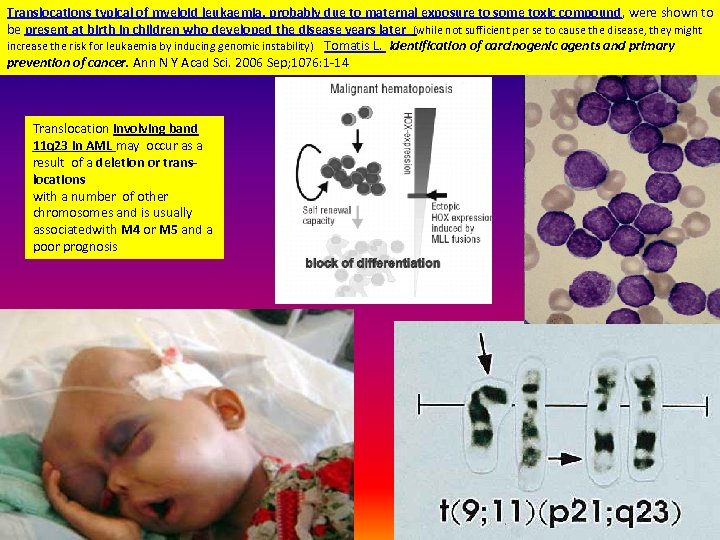 Translocations typical of myeloid leukaemia, probably due to maternal exposure to some toxic compound,