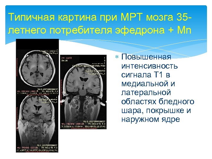 Типичная картина при МРТ мозга 35 летнего потребителя эфедрона + Mn Повышенная интенсивность сигнала