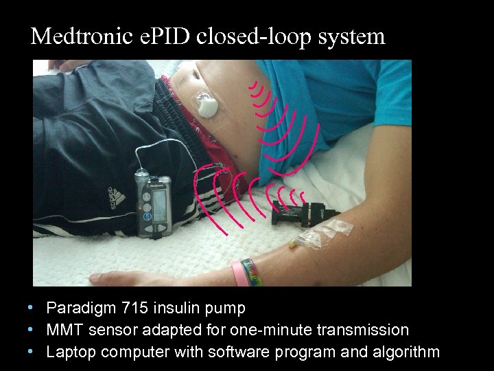 Medtronic e. PID closed-loop system • Paradigm 715 insulin pump • MMT sensor adapted