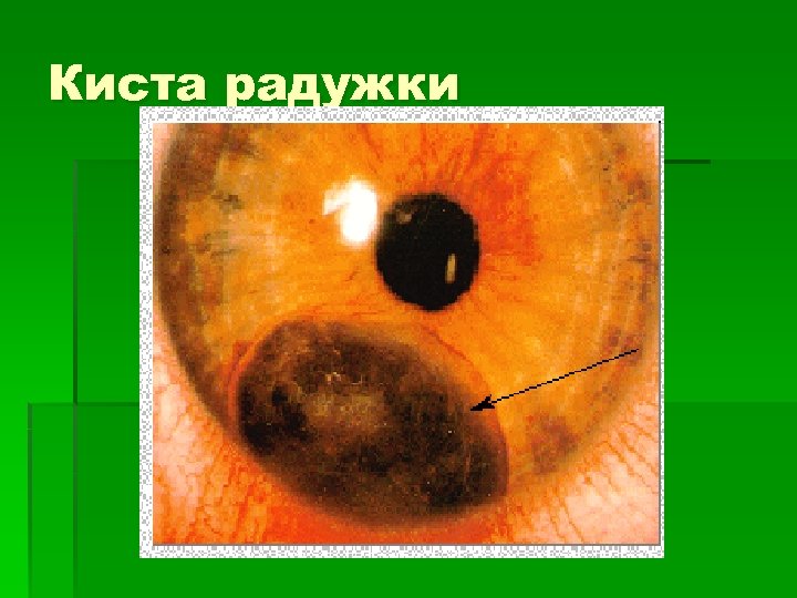 Киста радужки 
