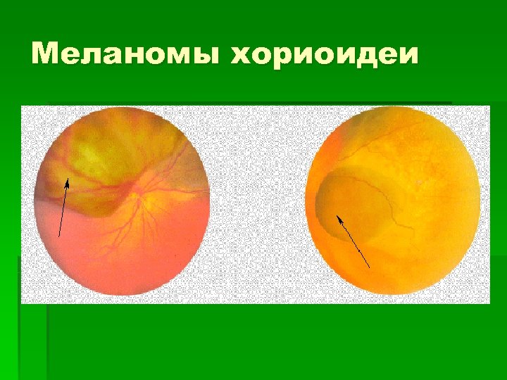 Меланомы хориоидеи 