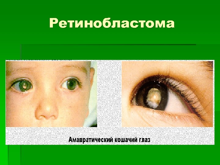 Ретинобластома 