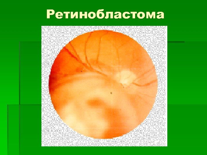 Ретинобластома. Ретинобластома офтальмоскопия. Ретинобластома хориоидеи. Ретинобластома у детей патанатомия. Ретинобластома презентация.