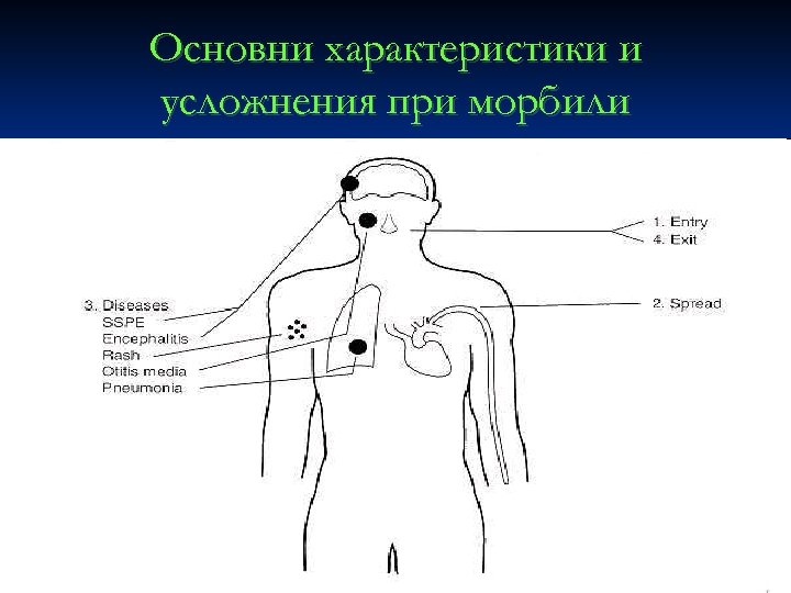 Основни характеристики и усложнения при морбили 
