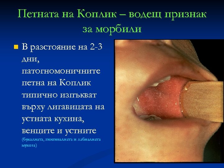 Петната на Коплик – водещ признак за морбили В разстояние на 2 -3 дни,